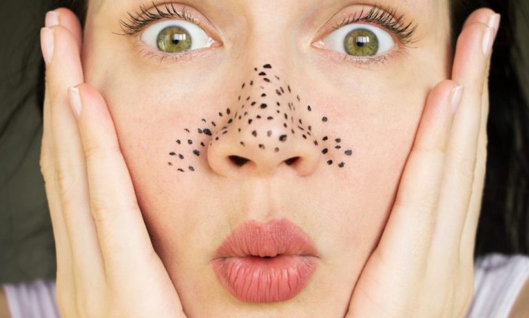 Siyah Noktaları Burnunuzdan Çıkarmanın 8 Yolu, Artı Önleme İpuçları